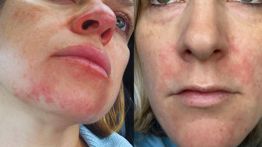 Perioral dermatitis - what is it??
